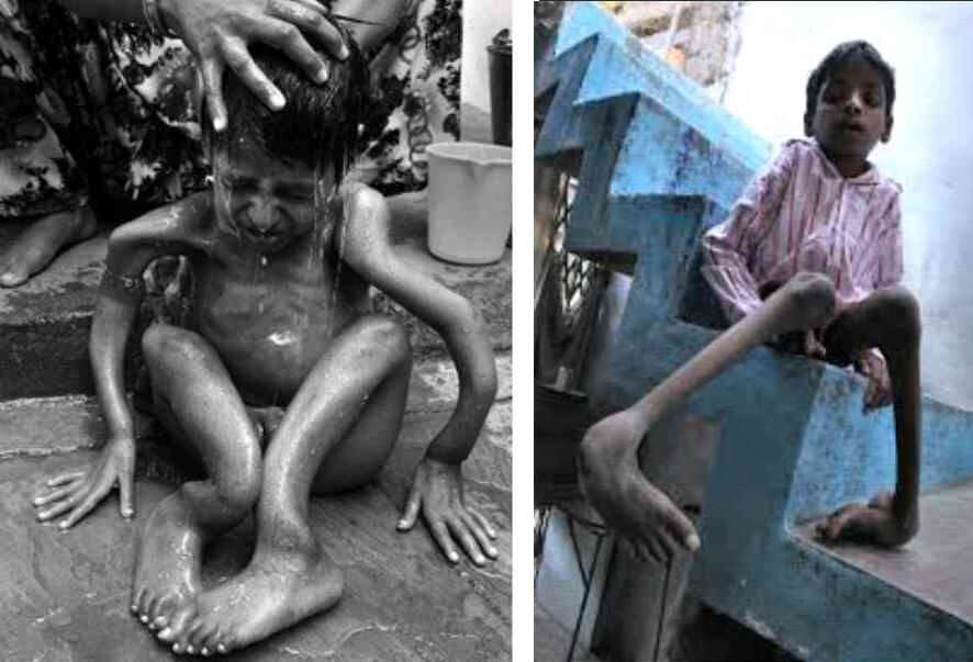 Figura 7. Niños con deformaciones congénitas producidas por el escape de gas de la planta de pesticidas de Union Carbide en Bohpal, India el 2 de diciembre de 1984.