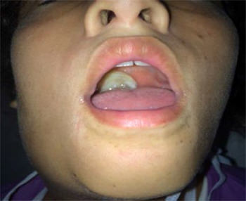 Foto: Cortesía de Dra. Cruz Cordero. Adolescente femenino, con seudomembranas grisáceas en faringe, unilateral. Edema de cuello. Caso sospechoso de Difteria. Cd Guayana. Octubre de 2016.